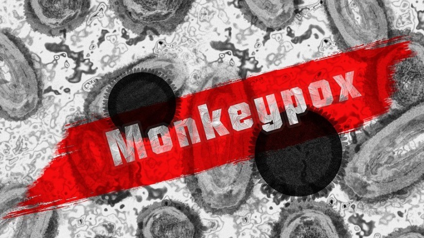 Posible caso de viruela del mono en la Región de Murcia en una persona de 50 años