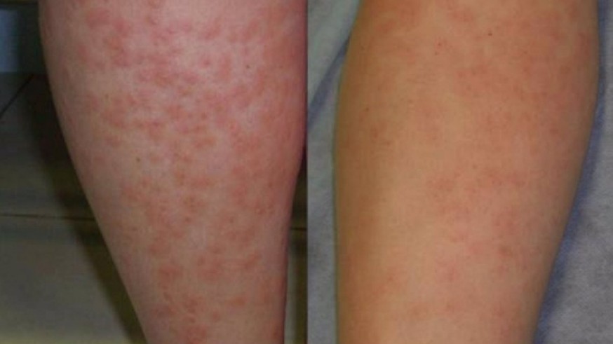 Día Mundial de la Dermatitis Atópica