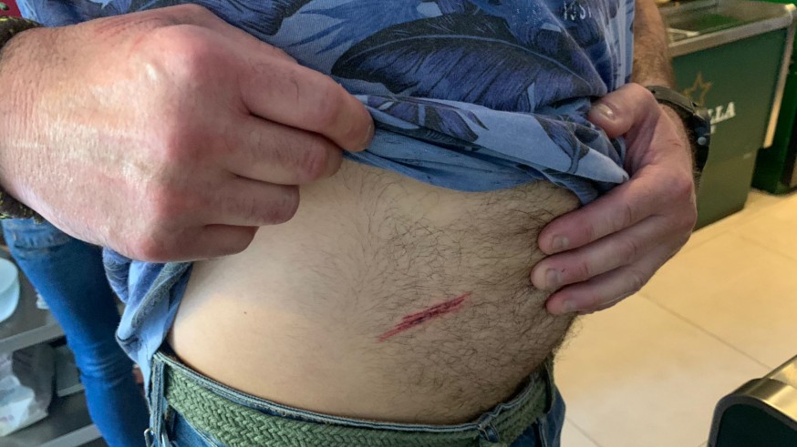 El hombre agredido muestra la herida en su abdomen. ORM