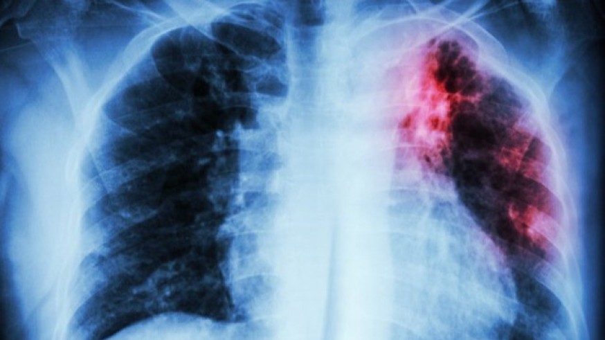 Radiografía de unos pulmones. EUROPA PRESS.