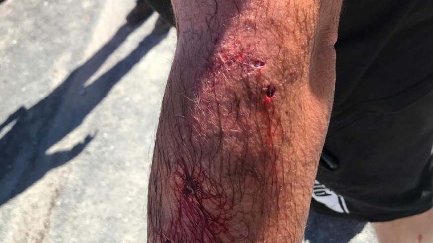 Heridas que sufrió el hombre en su brazo